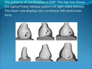 The patterns of calcification in EMF. The top row shows
the typical linear oblique pattern of right-sided disease.
The lower row displays the curvilinear left ventricular
form.
 