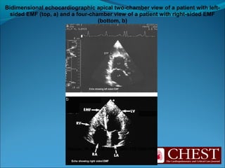 Hassan, W. M. et al. Chest 2005;128:3985-3992
Bidimensional echocardiographic apical two-chamber view of a patient with left-
sided EMF (top, a) and a four-chamber view of a patient with right-sided EMF
(bottom, b)
 