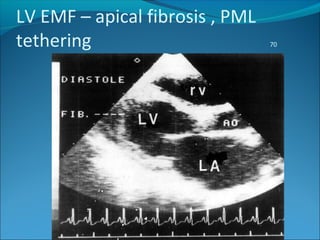 LV EMF – apical fibrosis , PML
tethering 70
 