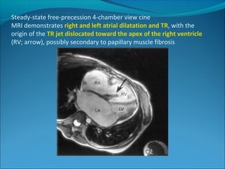 Steady-state free-precession 4-chamber view cine
MRI demonstrates right and left atrial dilatation and TR, with the
origin of the TR jet dislocated toward the apex of the right ventricle
(RV; arrow), possibly secondary to papillary muscle fibrosis
 