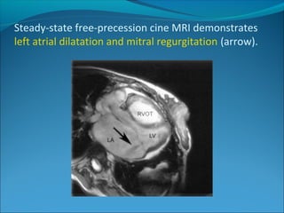 Steady-state free-precession cine MRI demonstrates
left atrial dilatation and mitral regurgitation (arrow).
 