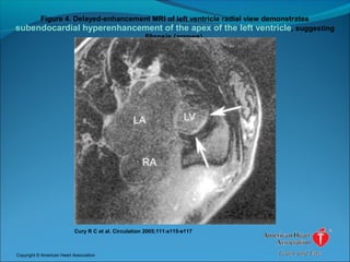 Figure 4. Delayed-enhancement MRI of left ventricle radial view demonstrates
subendocardial hyperenhancement of the apex of the left ventricle, suggesting
fibrosis (arrows).
Cury R C et al. Circulation 2005;111:e115-e117
Copyright © American Heart Association
 