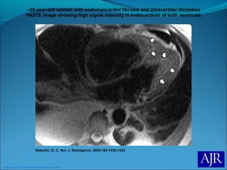 Copyright © 2006 by the American Roentgen Ray Society
Salanitri, G. C. Am. J. Roentgenol. 2005;184:1432-1433
--59-year-old woman with endomyocardial fibrosis and intracardiac thrombus
HASTE image showing high signal intensity in endocardium of both ventricles
 