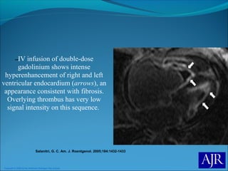 Copyright © 2006 by the American Roentgen Ray Society
Salanitri, G. C. Am. J. Roentgenol. 2005;184:1432-1433
--IV infusion of double-dose
gadolinium shows intense
hyperenhancement of right and left
ventricular endocardium (arrows), an
appearance consistent with fibrosis.
Overlying thrombus has very low
signal intensity on this sequence.
 