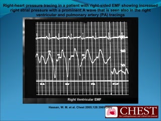 Hassan, W. M. et al. Chest 2005;128:3985-3992
Right-heart pressure tracing in a patient with right-sided EMF showing increased
right atrial pressure with a prominent A wave that is seen also in the right
ventricular and pulmonary artery (PA) tracings
 