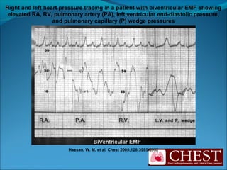 Hassan, W. M. et al. Chest 2005;128:3985-3992
Right and left heart pressure tracing in a patient with biventricular EMF showing
elevated RA, RV, pulmonary artery (PA), left ventricular end-diastolic pressure,
and pulmonary capillary (P) wedge pressures
 