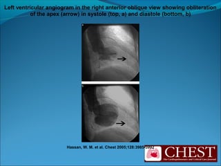 Hassan, W. M. et al. Chest 2005;128:3985-3992
Left ventricular angiogram in the right anterior oblique view showing obliteration
of the apex (arrow) in systole (top, a) and diastole (bottom, b)
 