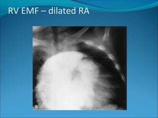 RV EMF – dilated RA
 