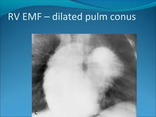 RV EMF – dilated pulm conus
 