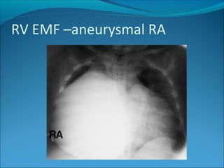 RV EMF –aneurysmal RA
 