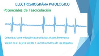 ELECTROMIOGRÁMA PATOLÓGICO
Potenciales de Fasciculación
Conocidas como mioquimias producidas espontáneamente
Visible en el sujeto similar a un tick nervioso de los parpados
 