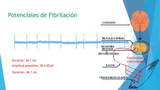 Potenciales de Fibrilación
Continuidad
interrumpidaDuracion: de 1 ms
Amplitud pequeñas: 30 a 50 pV
Duracion: de 1 ms
 