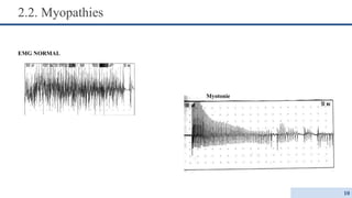 2.2. Myopathies
EMG NORMAL
Myotonie
10
 