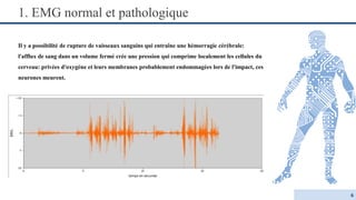 EMG anormal | PPT