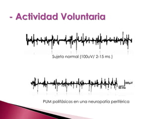 Sujeto normal (100uV/ 2-15 ms )
PUM polifásicos en una neuropatía periférica
 