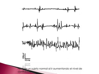 PUM de un sujeto normal al ir aumentando el nivel de
contracción.
 
