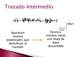 Aparecen
nuevos
potenciales que
densifican el
trazado
Escasos
trechos netos
con línea de
base
discernible
 