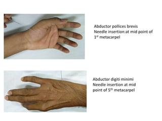 Abductor pollices brevis
Needle insertion:at mid point of
1st metacarpel
Abductor digiti minimi
Needle insertion at mid
point of 5th metacarpel
 