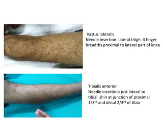Vastus lateralis
Needle insertion: lateral thigh 4 finger
breadths proximal to lateral part of knee
Tibialis anterior
Needle insertion: just lateral to
tibial shin at junction of proximal
1/3rd and distal 2/3rd of tibia
 