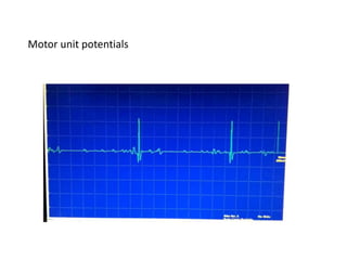 Motor unit potentials
 