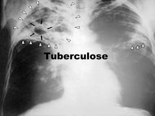 Tuberculose  