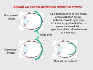 Uncorrected
Myope
“Corrected”
Myope
Image Shell
As a consequence of eye shape
and/or aspheric optical
surfaces, myopic eyes may
experience significant defocus
across the visual field,
regardless of the refractive state
at the fovea.
Should we correct peripheral refractive errors?
Optimal Correction?
 