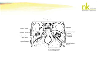 Midsaggital Line
Angle at which the plane of
the anterior semicircular duct
crosses the midsaggital line
Cochlear
Anterior
Semicircular ducts:
Horizontal
Posterior
Internal Acoustic
Meatus
Cochlear Nerve
Vestibular Nerve
Vestibulocochlear
nerve (VIII)
Foramen Magnum
 