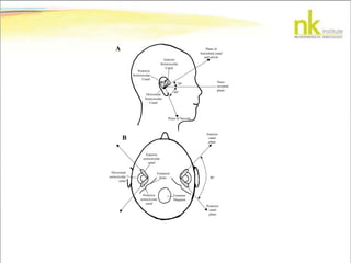 A
B
Anterior
Semicircular
Canal
Posterior
Semicircular
Canal
Horizontal
Semicircular
Canal
Plane of Saccule
Plane of
horizontal canal
and utricle
Naso-
occipital
plane
60
30
90
Horizontal
semicircular
canal
Anterior
semicircular
canal
Posterior
semicircular
canal
Foramen
Magnum
Temporal
bone
Anterior
canal
plane
Posterior
canal
plane
 