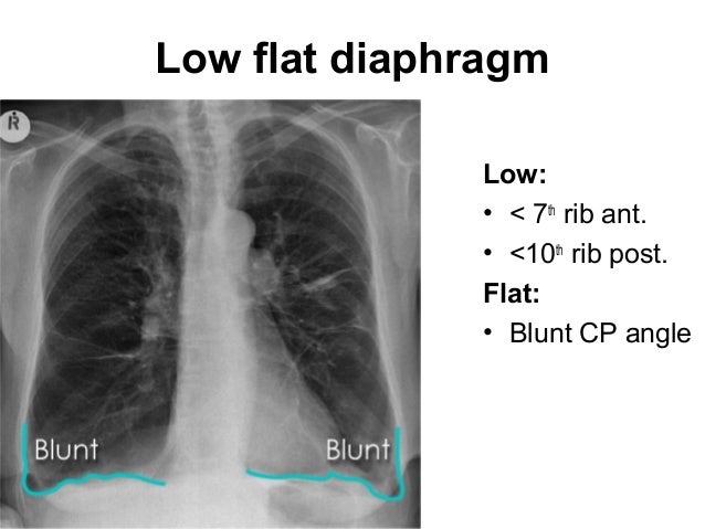 Emphysema