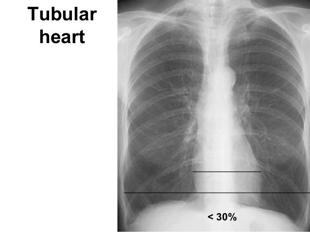tubular heart