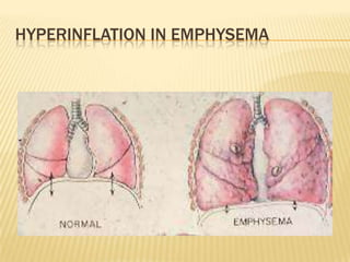 HYPERINFLATION IN EMPHYSEMA

 