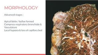 MORPHOLOGY
Advanced stages :
Apical blebs / bullae formed
Compress respiratory bronchiole &
Vasculature
Local hypoxia & loss of capillary bed
 