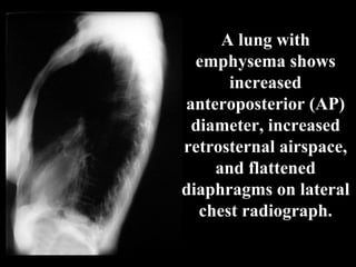A lung with
  emphysema shows
      increased
anteroposterior (AP)
 diameter, increased
retrosternal airspace,
    and flattened
diaphragms on lateral
  chest radiograph.
 