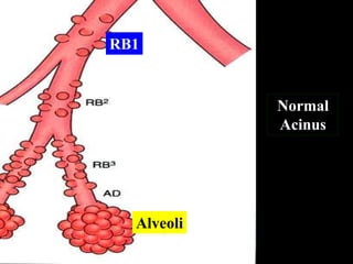 RB1


            Normal
            Acinus




  Alveoli
 