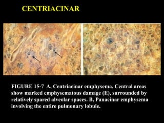 CENTRIACINAR




FIGURE 15-7 A, Centriacinar emphysema. Central areas
show marked emphysematous damage (E), surrounded by
relatively spared alveolar spaces. B, Panacinar emphysema
involving the entire pulmonary lobule.
 