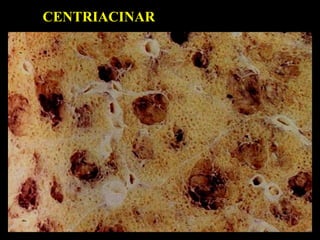 CENTRIACINAR
 
