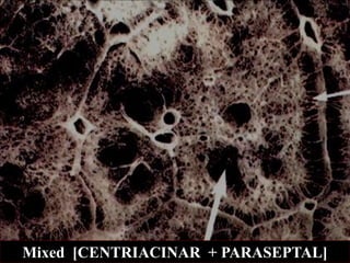 Mixed [CENTRIACINAR + PARASEPTAL]
 