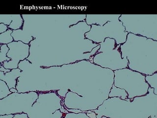 Emphysema - Microscopy
 