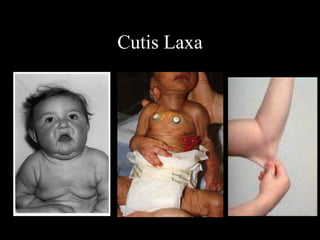Cutis Laxa
 