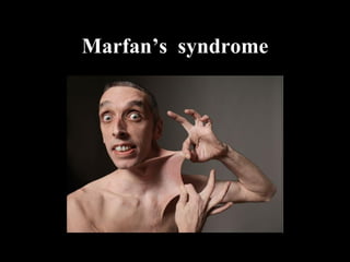 Marfan’s syndrome
 