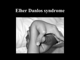 Elher Danlos syndrome
 