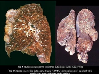 Fig-1 Bullous emphysema with large subpleural bullae (upper left)
Fig-2 Chronic obstructive pulmonary disease (COPD). Gross pathology of a patient with
 