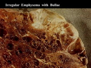 Irregular Emphysema with Bullae
 