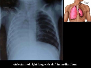 Atelectasis of right lung with shift in mediastinum
 