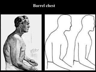 Barrel chest
 