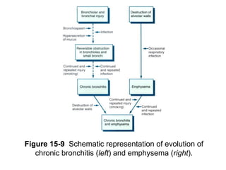 Figure 15-9 Schematic representation of evolution of
   chronic bronchitis (left) and emphysema (right).
 