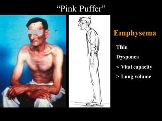 “Pink Puffer”

                Emphysema
                Thin
                Dysponea
                < Vital capacity
                > Lung volume
 