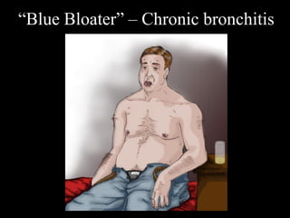 “Blue Bloater” – Chronic bronchitis
 