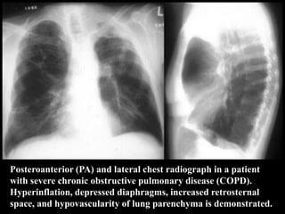 Posteroanterior (PA) and lateral chest radiograph in a patient
with severe chronic obstructive pulmonary disease (COPD).
Hyperinflation, depressed diaphragms, increased retrosternal
space, and hypovascularity of lung parenchyma is demonstrated.
 