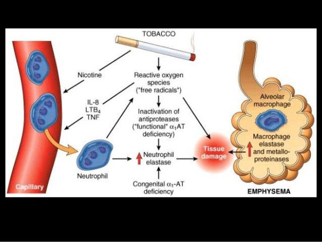 emphysema pathophysiology of emphysema flow chart